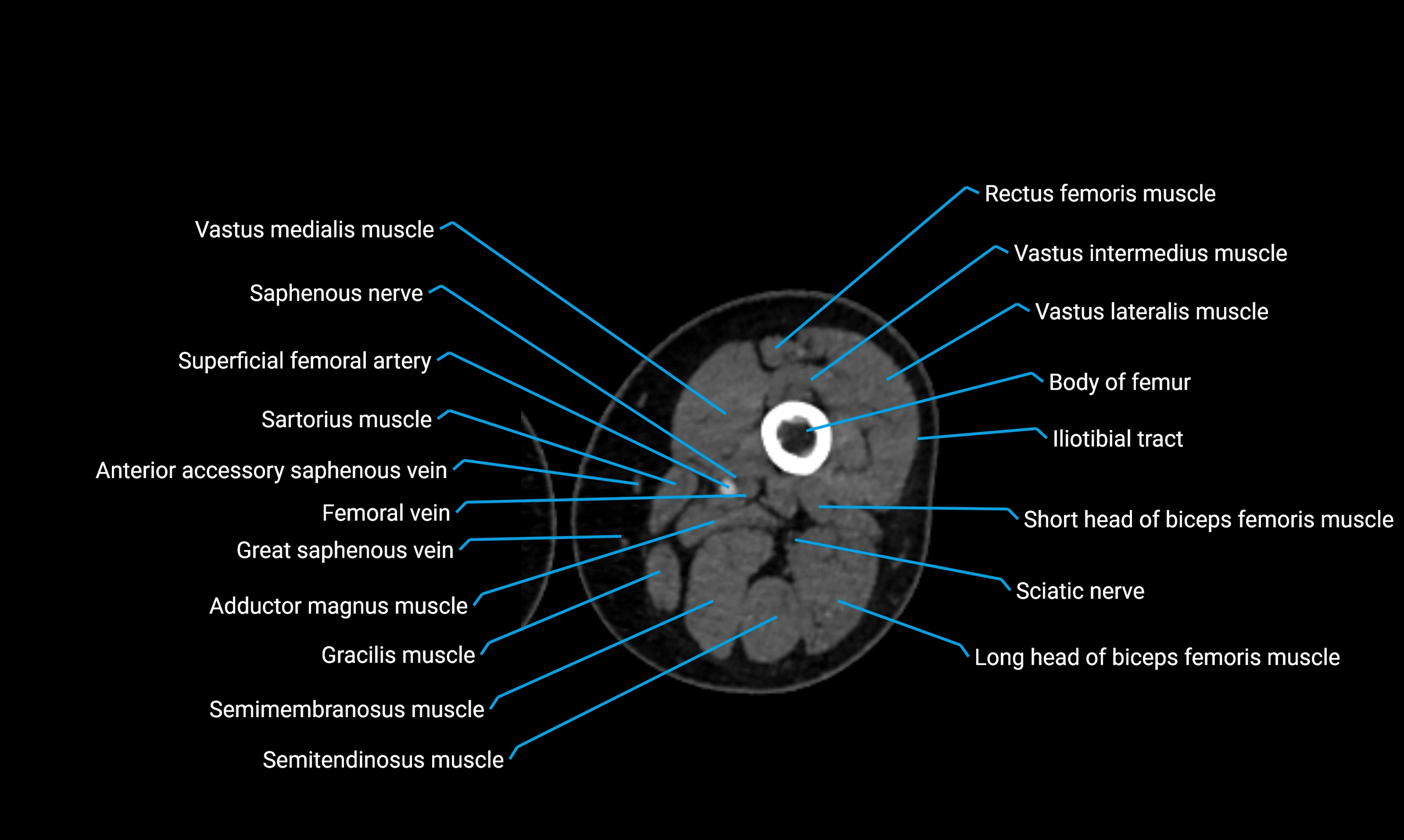 CT thigh axial cross sectional anatomy labelled image_59 (2).webp